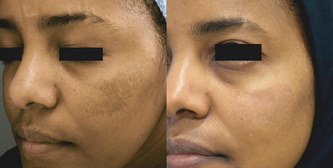 before and after pico laser treatment for sun spot removal