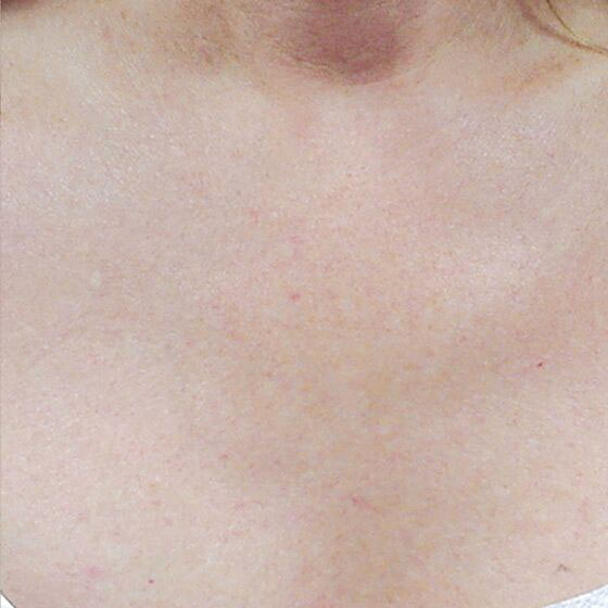 Skin after IPL treatment for sunspots and freckles in Denver