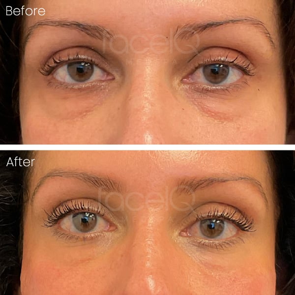 patient with under eye bags before and after filler treatment