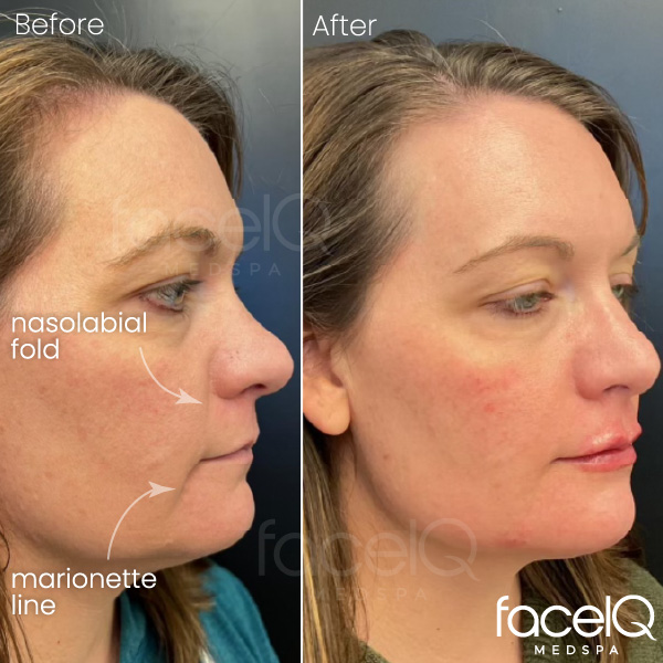 patient before and after an injectable treatment for nasolabial folds, smile line, and marionette lines 