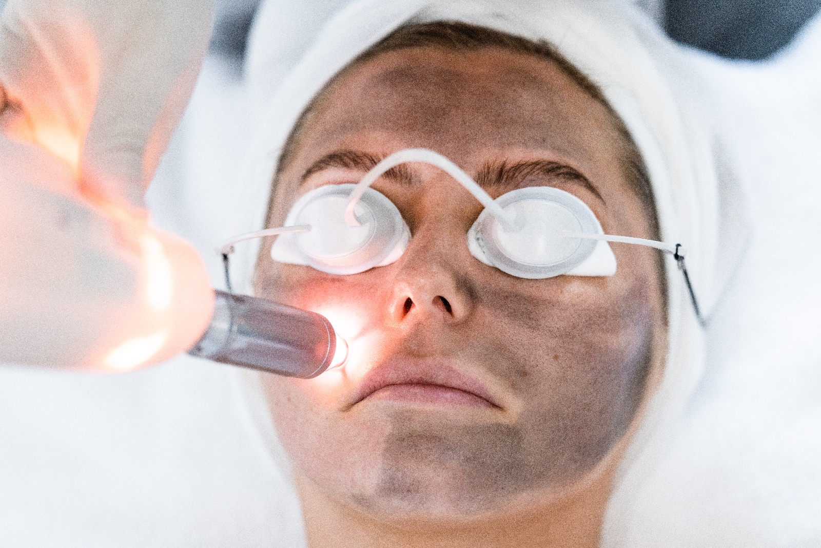 carbon laser facial