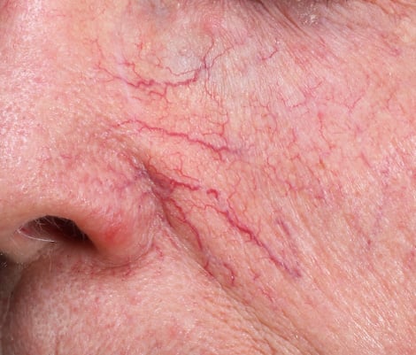 Before &mdash; visible vascular redness and fine lines