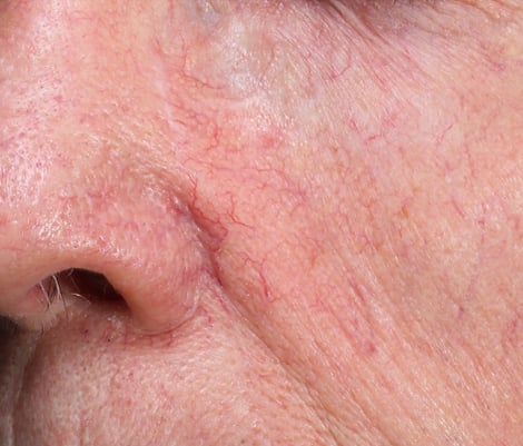 After one treatment &mdash; capillaries cleared