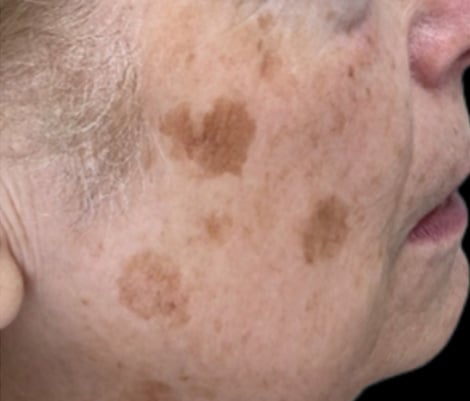 Before &mdash; pigmentation and sun damage