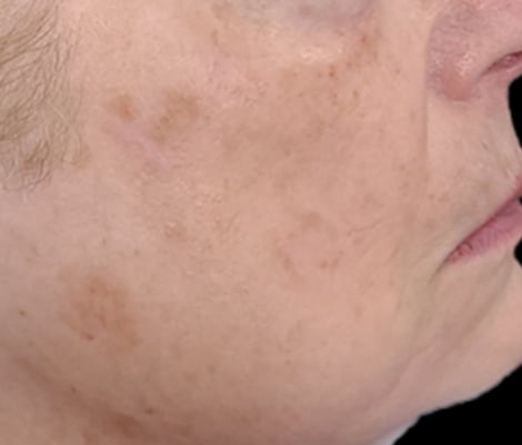 After two treatments &mdash; pigmentation reduced