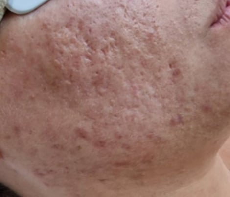 Before &mdash; acne scarring and pore texture