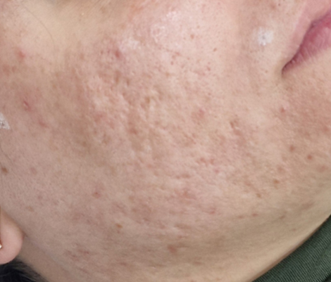 After six treatments &mdash; smoother texture
