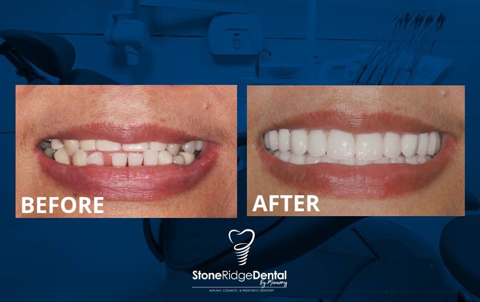 Dental Implants San Antonio's 1 Choice for Cosmetic Dentistry