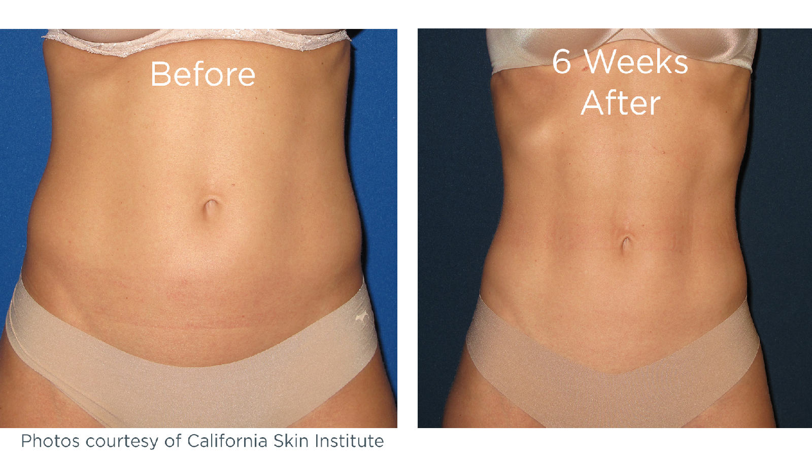 Picture of before and after results of CoolSculpting used on the abdomen.