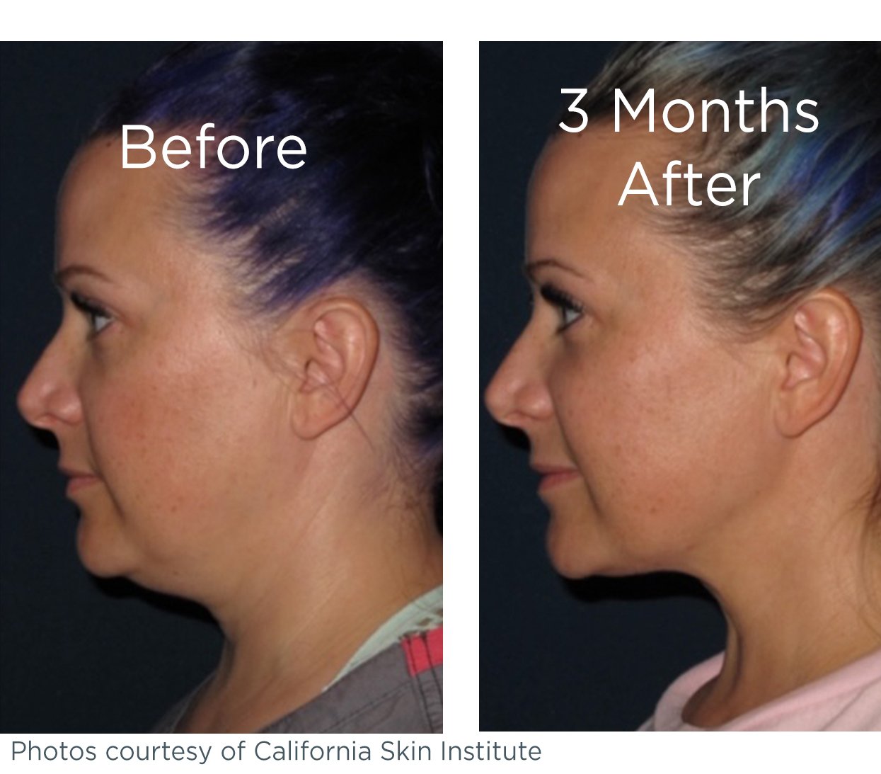 before and after results of CoolSculpting applied to the Submental area