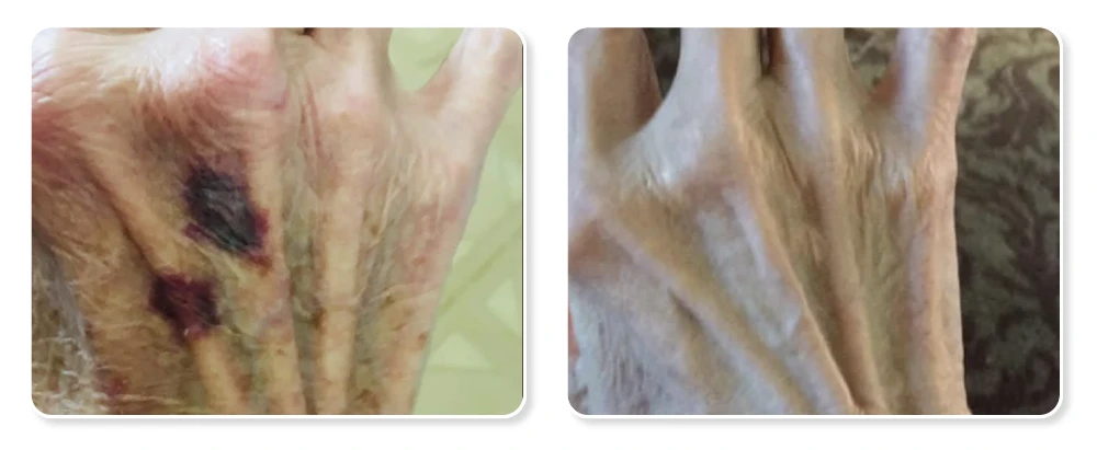 Before and after: hands showing bruising before collagen, then healed skin after