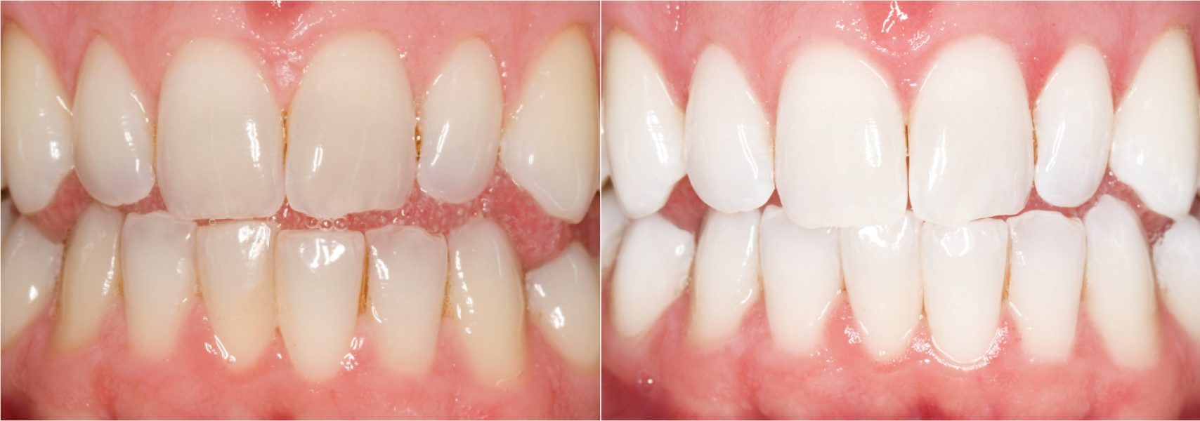 Opalescence Whitening: before and after