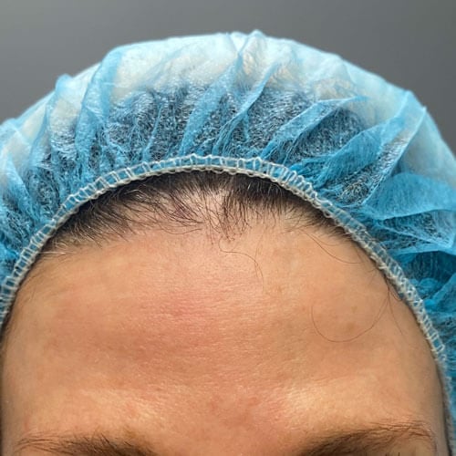 Forehead Wrinkles After Treatment