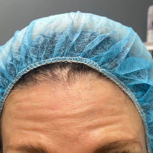 Forehead Wrinkles Before