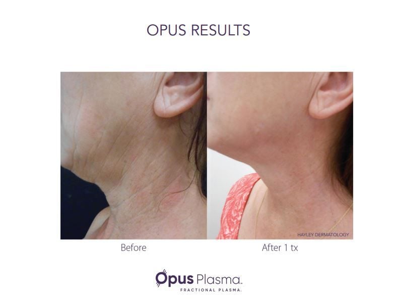 Opus Plasma result