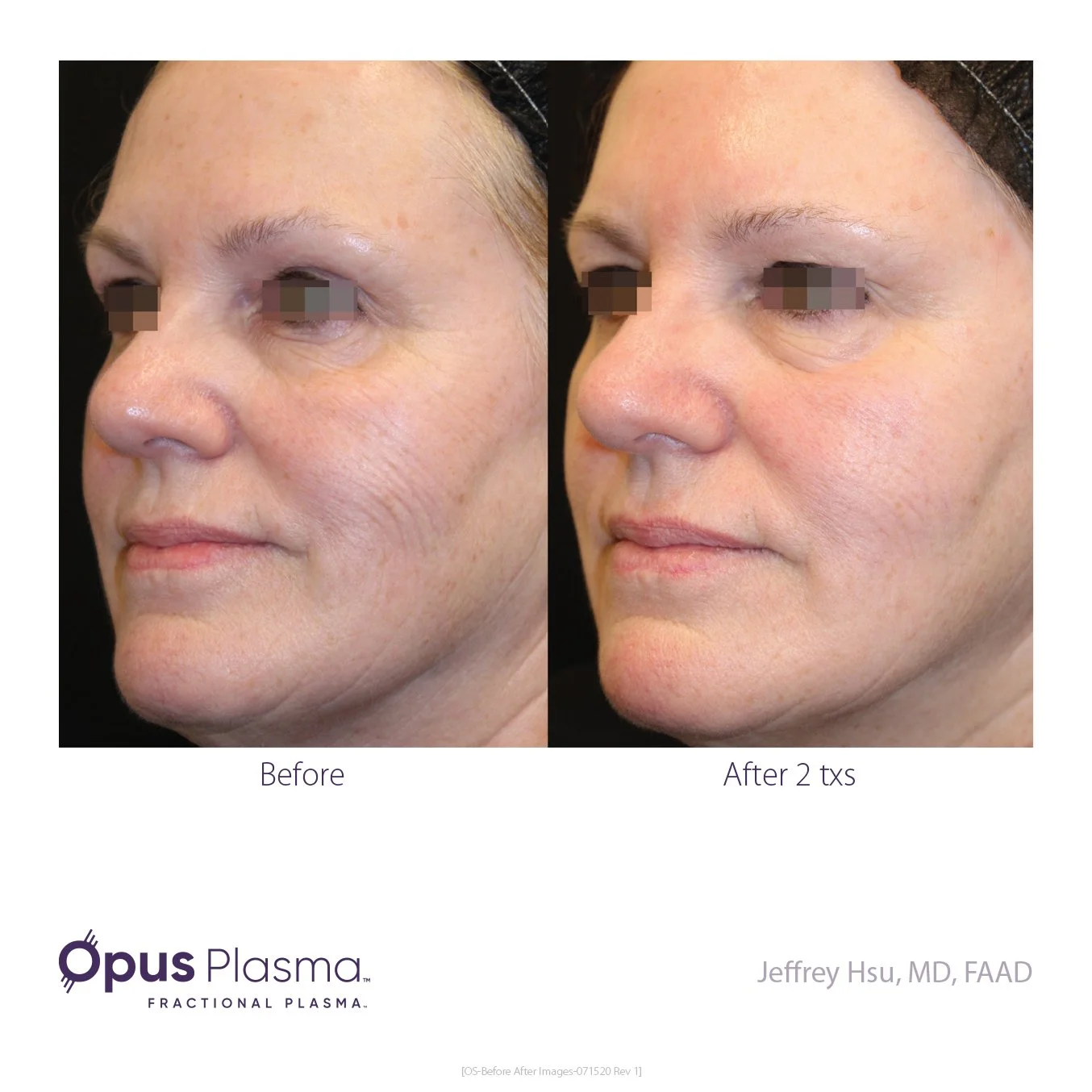 Opus Plasma result