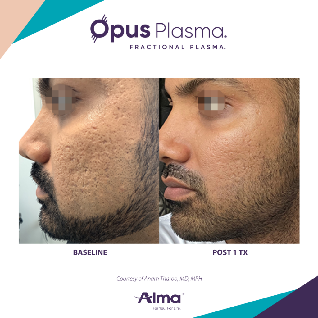 Opus Plasma result