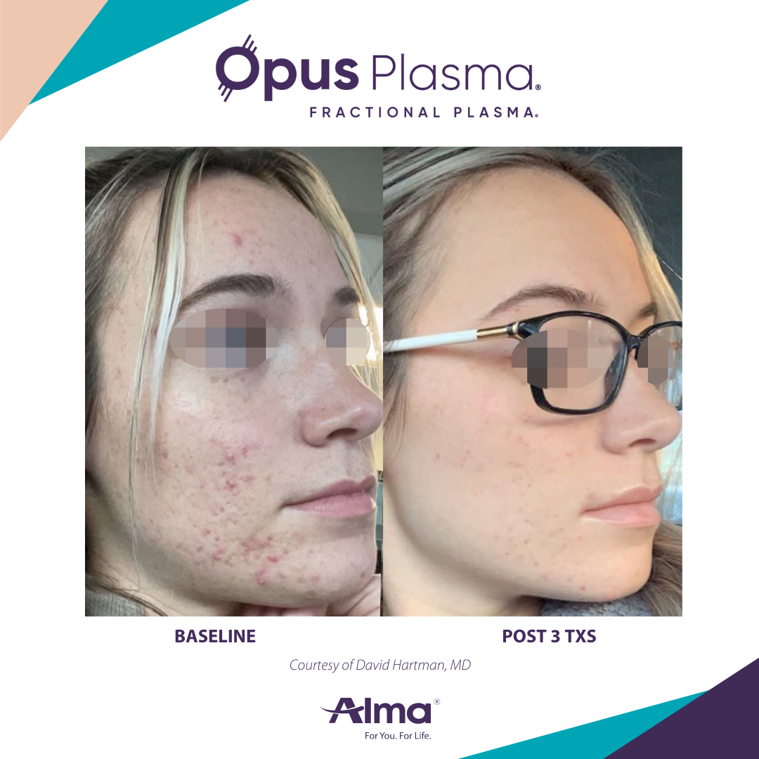 Opus Plasma result