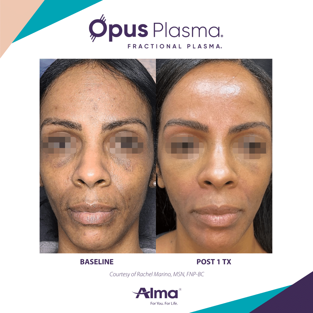 Opus Plasma result